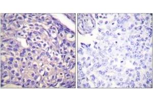 Immunohistochemistry analysis of paraffin-embedded human breast carcinoma tissue, using MYPT1 (Ab-696) Antibody. (PPP1R12A anticorps  (AA 661-710))