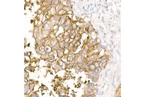 Immunohistochemistry of paraffin-embedded Human lung squamous carcinoma tissue using TROP-2 antibody (ABIN7271103) at dilution of 1:2700 (40x lens).
