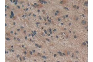 Detection of dSIP in Human Glioma Tissue using Polyclonal Antibody to Delta-Sleep Inducing Peptide (dSIP) (dSIP (AA 1-134) anticorps)
