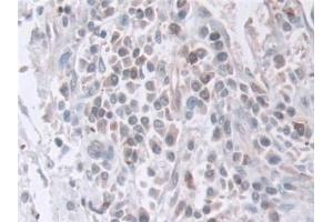 Detection of EXOSC2 in Human Prostate cancer Tissue using Polyclonal Antibody to Exosome Component 2 (EXOSC2)