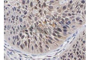 ABIN6268641 at 1/100 staining Human Breast Cancer tissue sections by IHC-P.