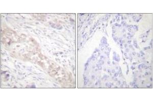 Immunohistochemistry analysis of paraffin-embedded human breast carcinoma, using Smad2 (Phospho-Ser467) Antibody.
