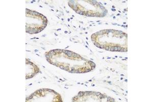 Immunohistochemistry of paraffin-embedded human gastric using NEDD4 antibody (ABIN1681009, ABIN3015207, ABIN3015208 and ABIN6213883) at dilution of 1:200 (40x lens). (NEDD4 anticorps  (AA 160-460))