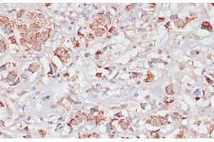 Immunohistochemistry of paraffin-embedded Human breast cancer using Desmoplakin Polyclonal Antibody at dilution of 1:100 (40x lens). (Desmoplakin anticorps)