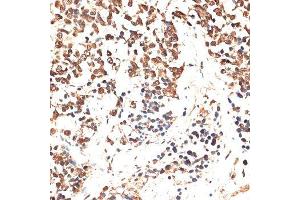 Immunohistochemistry of paraffin-embedded human lung cancer using MCM5 antibody. (MCM5 anticorps  (AA 1-230))