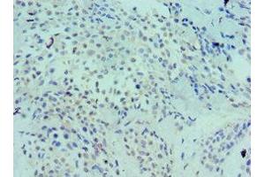 Immunohistochemistry of paraffin-embedded human breast cancer using ABIN7158577 at dilution of 1:100