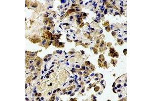 Immunohistochemical analysis of RPS20 staining in human lung cancer formalin fixed paraffin embedded tissue section. (RPS20 anticorps)
