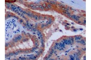 Detection of CK8 in Human Thyroid cancer Tissue using Polyclonal Antibody to Cytokeratin 8 (CK8)