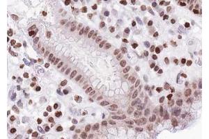 ABIN6267628 at 1/100 staining human Stomach carcinoma tissue sections by IHC-P. (FOXO1/3/4-pan anticorps  (pThr24, pThr32))