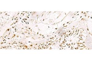 Immunohistochemistry of paraffin-embedded Human lung cancer tissue using PDS5A Polyclonal Antibody at dilution of 1:90(x200) (PDS5A anticorps)