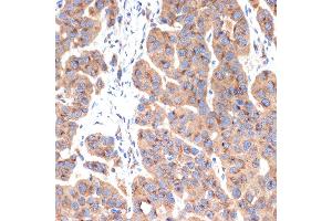 Immunohistochemistry of paraffin-embedded human esophageal cancer using G1 Rabbit mAb (ABIN7265446) at dilution of 1:100 (40x lens).