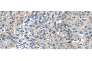 Immunohistochemistry of paraffin-embedded Human breast cancer using GLP2R Polyclonal Antibody at dilution of 1/30 (GLP2R anticorps)