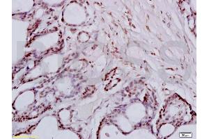 Formalin-fixed and paraffin embedded human colon carcinoma tissue labeled with Anti-FRA2/FOSL2 Polyclonal Antibody, Unconjugated (ABIN673104) at 1:200 followed by conjugation to the secondary antibody and DAB staining (FOSL2 anticorps  (AA 231-326))