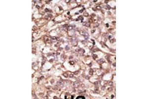 Formalin-fixed and paraffin-embedded human cancer tissue reacted with the primary antibody, which was peroxidase-conjugated to the secondary antibody, followed by DAB staining.