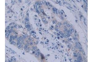 Detection of YARS in Human Colorectal cancer Tissue using Polyclonal Antibody to Tyrosyl tRNA Synthetase (YARS)