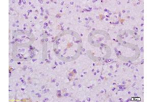 Formalin-fixed and human glioma tissue labeled with Anti-MAP1A Polyclonal Antibody (ABIN735308), Unconjugated at 1:200 followed by conjugation to the secondary antibody and DAB staining (MAP1A anticorps  (AA 2651-2750))