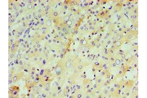 Immunohistochemistry of paraffin-embedded human liver tissue using ABIN7156608 at dilution of 1:100 (IL29 anticorps  (AA 21-200))