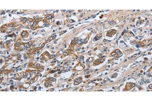 Immunohistochemistry of paraffin-embedded Human gasrtic cancer tissue using SLC34A2 Polyclonal Antibody at dilution of 1:50 (SLC34A2 anticorps)