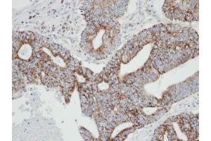 IHC-P Image Immunohistochemical analysis of paraffin-embedded human endo mitral OCVA , using RAB2A, antibody at 1:100 dilution. (RAB2A anticorps  (C-Term))