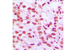 Immunohistochemical analysis of ELK1 (pS389) staining in human breast cancer formalin fixed paraffin embedded tissue section. (ELK1 anticorps  (C-Term, pSer389))