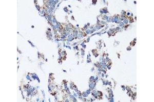 Immunohistochemistry of paraffin-embedded Human gastric cancer using SRC Polyclonal Antibody at dilution of 1:100 (40x lens). (Src anticorps)