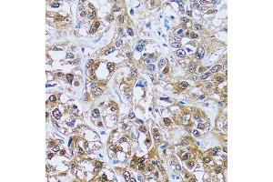 Immunohistochemistry of paraffin-embedded human liver cancer using IMPA1 antibody. (IMPA1 anticorps  (AA 1-277))