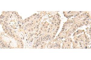 Immunohistochemistry of paraffin-embedded Human thyroid cancer tissue using ZGPAT Polyclonal Antibody at dilution of 1:35(x200) (ZGPAT anticorps)