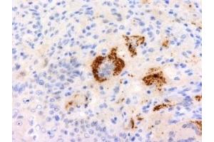 Formalin-fixed, paraffin-embedded human Erdheim Chester disease (also known as polyostotic sclerosing histiocytosis) stained with TNF-a antibody (P/T2).