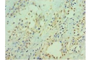 Immunohistochemistry of paraffin-embedded human breast cancer using ABIN7156537 at dilution of 1:100 (ICAM2 anticorps  (AA 25-223))