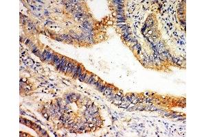 IHC-P: SLC1A4 antibody testing of human intestine cancer tissue (SLC1A4 anticorps  (C-Term))