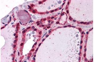 Human Thyroid: Formalin-Fixed, Paraffin-Embedded (FFPE) (IRAK1 anticorps  (AA 530-693))