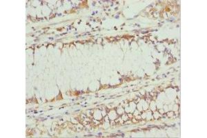 Immunohistochemistry of paraffin-embedded human colon cancer using ABIN7163636 at dilution of 1:100 (PLEKHA1 anticorps  (AA 285-404))
