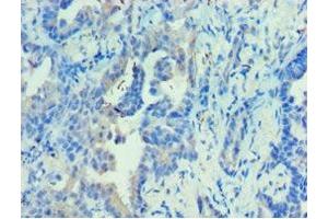 Immunohistochemistry of paraffin-embedded human lung cancer using ABIN7142680 at dilution of 1:100