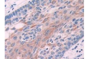 Detection of KRT6C in Human Skin cancer Tissue using Polyclonal Antibody to Keratin 6C (KRT6C)