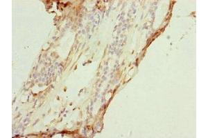 Immunohistochemistry of paraffin-embedded human breast cancer using ABIN7149183 at dilution of 1:100 (COX7A2L anticorps  (AA 1-114))
