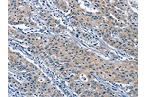 The image on the left is immunohistochemistry of paraffin-embedded Human gastric cancer tissue using ABIN7130004(KLF7 Antibody) at dilution 1/60, on the right is treated with fusion protein. (KLF7 anticorps)