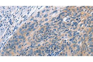 Immunohistochemistry of paraffin-embedded Human cervical cancer tissue using CUL7 Polyclonal Antibody at dilution 1:50 (Cullin 7 anticorps)