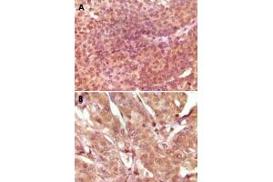 Immunohistochemical analysis of paraffin-embedded human bladder carcinoma (A) and breast carcinoma (B), showing nuclear and cytoplasmic localization using SRA1 monoclonal antibody, clone 7H1G1  with DAB staining. (SRA1 anticorps)