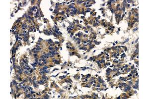 ABIN7097113 and ABIN7101180 at 1/100 staining human colorectal cancer by IHC-P. (LRRC3B anticorps)
