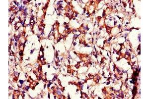 Immunohistochemistry of paraffin-embedded human gastric cancer using ABIN7159104 at dilution of 1:100 (MED12 anticorps  (AA 1742-2011))