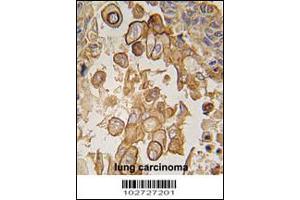 Formalin-fixed and paraffin-embedded human lung carcinoma tissue reacted with Mouse TLR6 antibody , which was peroxidase-conjugated to the secondary antibody, followed by DAB staining.