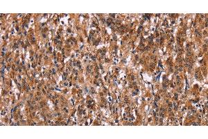 Immunohistochemistry of paraffin-embedded Human gasrtic cancer tissue using LILRB1 Polyclonal Antibody at dilution 1:50 (LILRB1 anticorps)