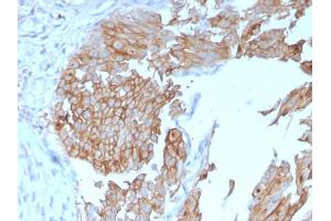Formalin-fixed, paraffin-embedded human Urothelial Carcinoma stained with Uroplakin 1B Mouse Monoclonal Antibody (UPK1B/3102). (Uroplakin 1B anticorps  (AA 109-229))