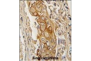 Formalin-fixed and paraffin-embedded human lung carcinoma tissue reacted with AC antibody (C-term) (ABIN391855 and ABIN2841687) , which was peroxidase-conjugated to the secondary antibody, followed by DAB staining. (ACPP anticorps  (C-Term))