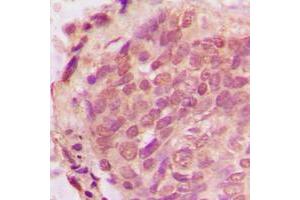 Immunohistochemical analysis of Ub staining in human breast cancer formalin fixed paraffin embedded tissue section.