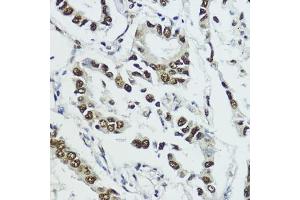 Immunohistochemistry of paraffin-embedded human lung cancer using Phospho-Histone H3-T11 antibody (ABIN3023615, ABIN3023616, ABIN3023617 and ABIN6225469) at dilution of 1:100 (40x lens). (Histone 3 anticorps  (pThr11))