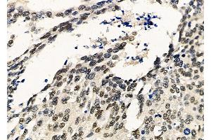 ABIN6259614 and ABIN6275390 at 1/100 staining Human ovarian cancer by IHC-P. (Pre-mRNA Branch Site Protein p14 (SF3B14) (C-Term) anticorps)