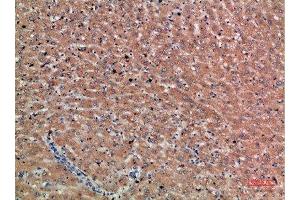 Immunohistochemical analysis of paraffin-embedded human-liver-cancer, antibody was diluted at 1:200