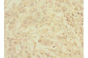 Immunohistochemistry of paraffin-embedded human pancreatic cancer using ABIN7174780 at dilution of 1:100 (C1ORF127 anticorps  (AA 401-648))