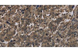 Immunohistochemistry of paraffin-embedded Human liver cancer using Histone H4 Polyclonal Antibody at dilution of 1:30 (Histone H4 anticorps)